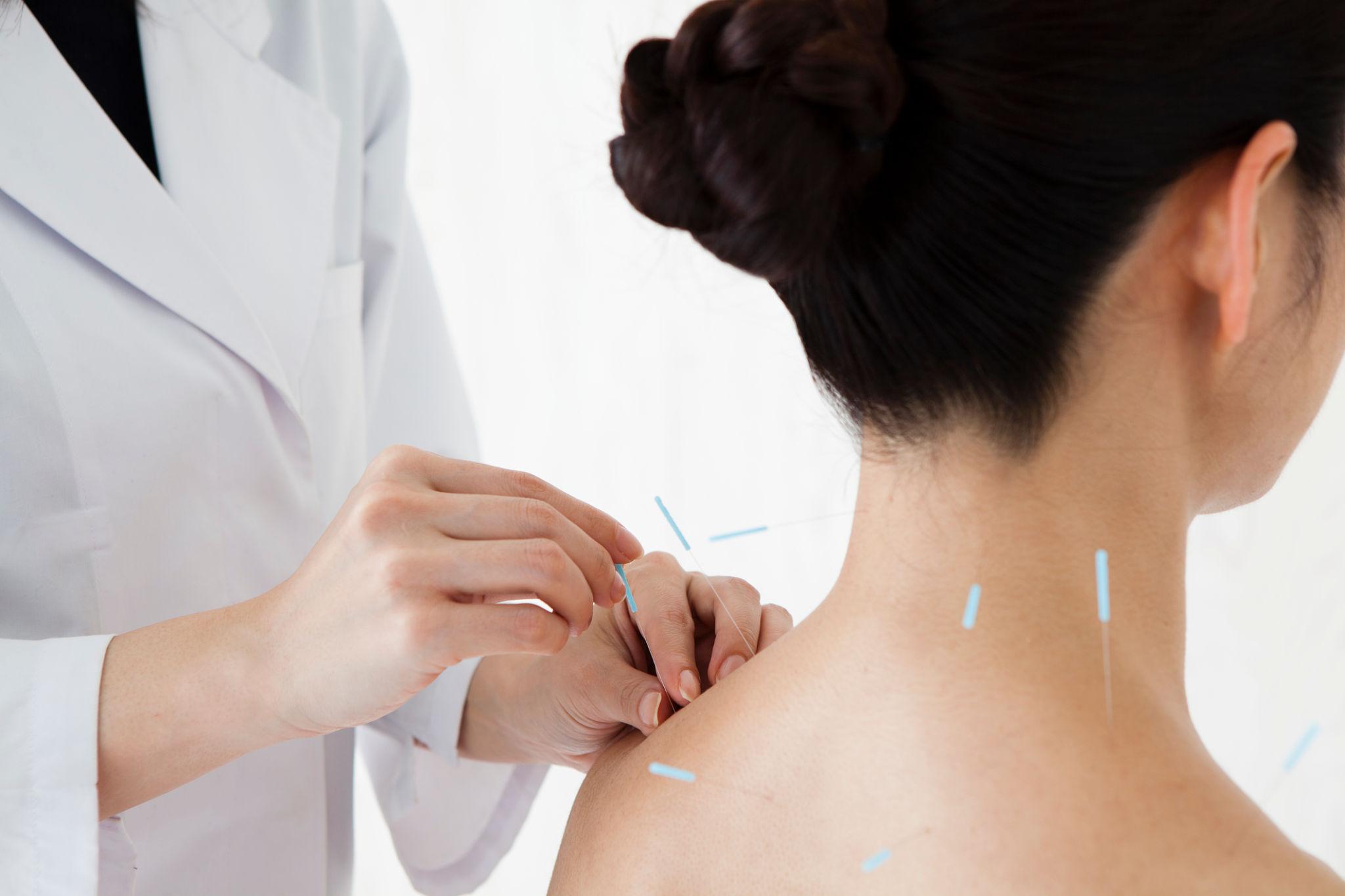 acupuncture